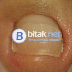 Поставям брекети (скоби ) за корегиране на враснали нокти.